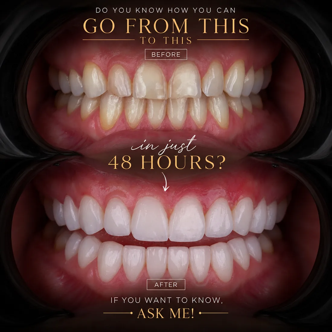 Close-up before and after porcelain veneers, natural white smile